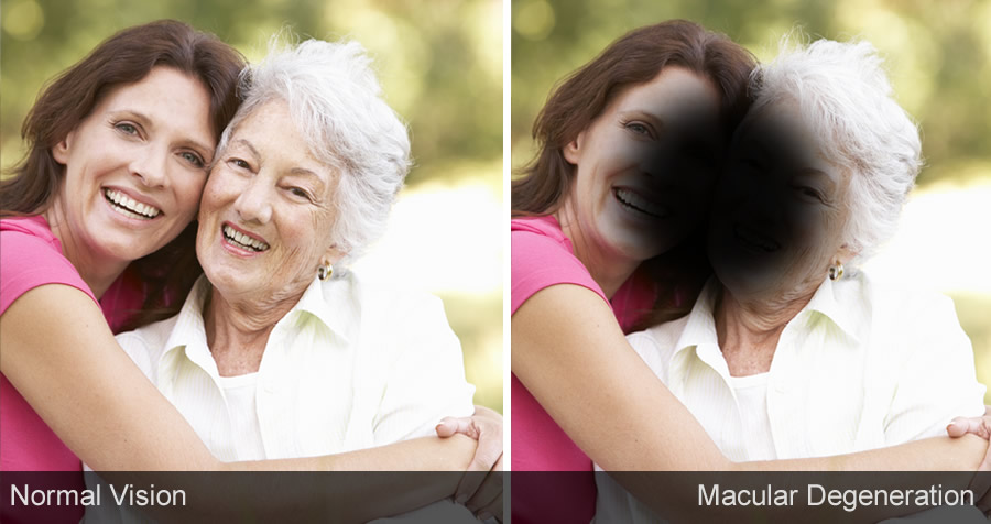 Macular degeneration example